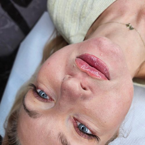 Powiększanie i modelowanie ust w Toruniu