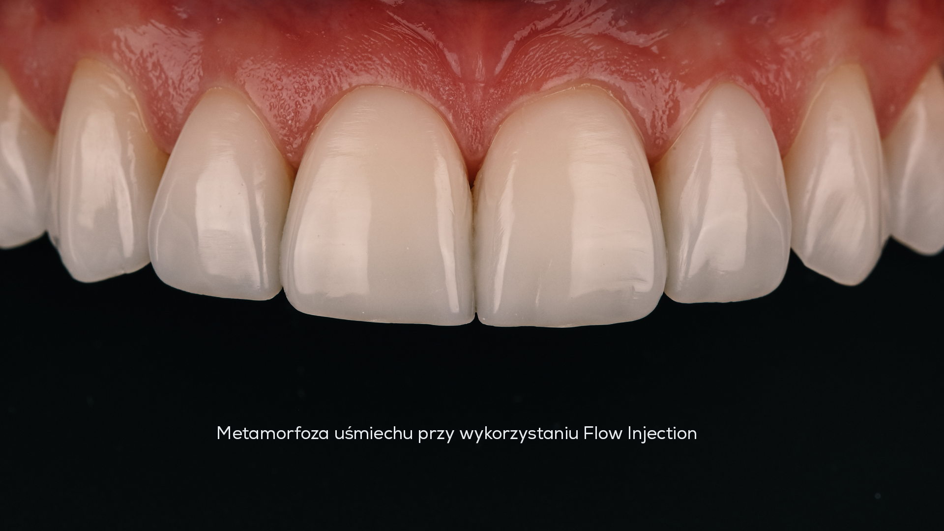 Efekt końcowy Flow injection w Le Perle w Poznaniu